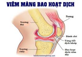 Viêm bao hoạt dịch khớp háng - Hình ảnh minh họa